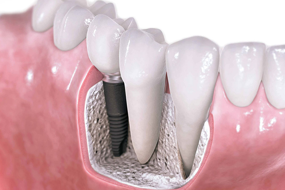 Implantología Tu Consulta Dental