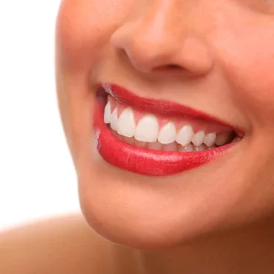 Blanqueamiento domiciliario bajo supervisión profesional