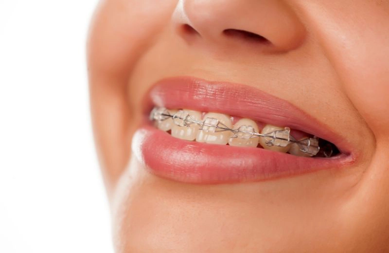 Brackets cerámicos en Tu Consulta Dental, clínica en Osuna de Alameda