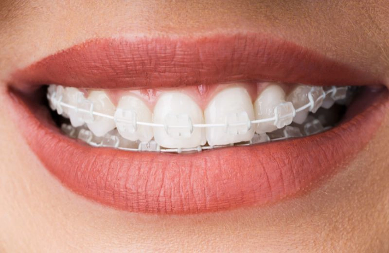 Brackets estéticos en Tu Consulta Dental, clínica en Alameda de Osuna