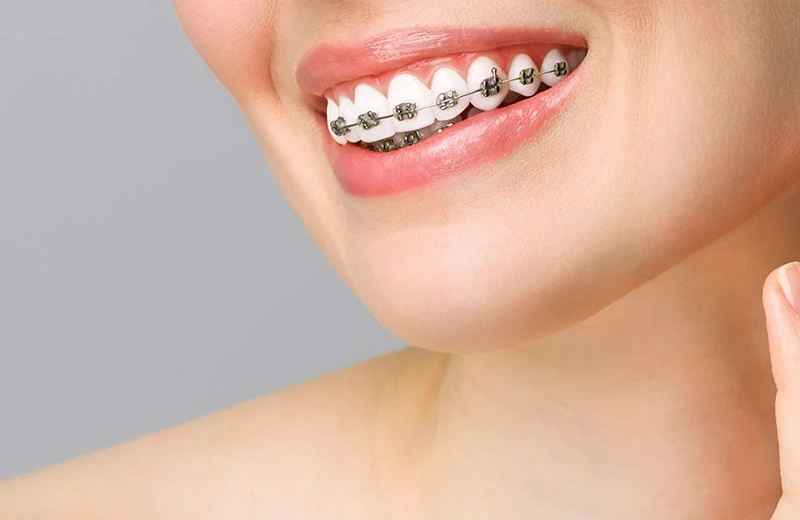 Brackets metálicos en Tu Consulta Dental, clínica especializada en ortodoncia